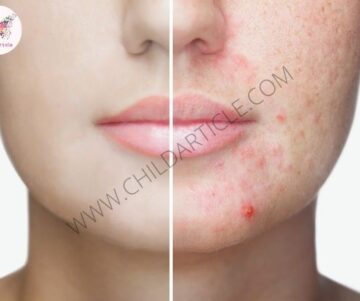 Acne Ko Kaise Hatye | TalkInHindi
